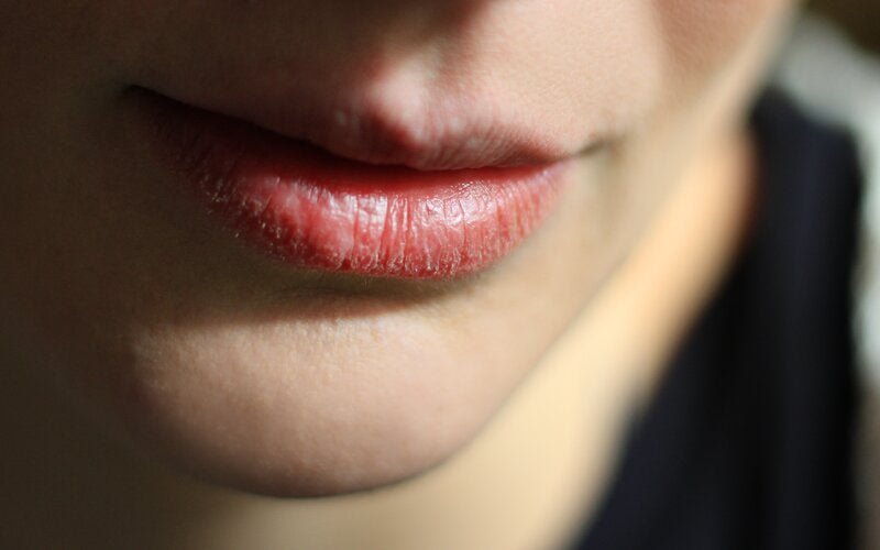 Trockene Lippen: 5 Tipps, die wirklich helfen - VitalBodyPLUS.de